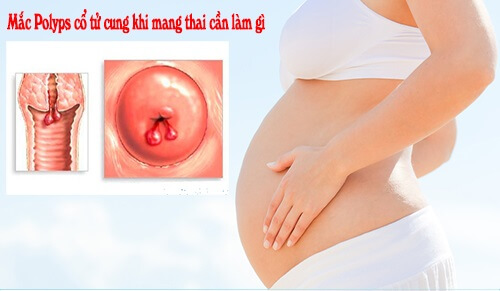 polyp cổ tử cung khi mang thai